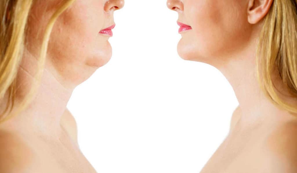 Double Chin treatment Kenilworth before and after results