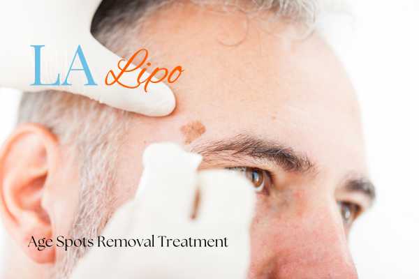 What Are the Most Effective Treatments for Age Spots Kenilworth?