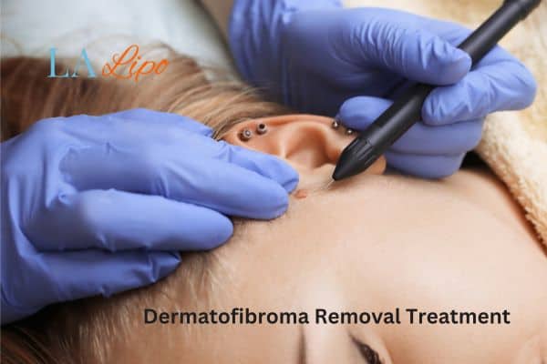 Dermatofibroma Removal Treatment Kenilworth