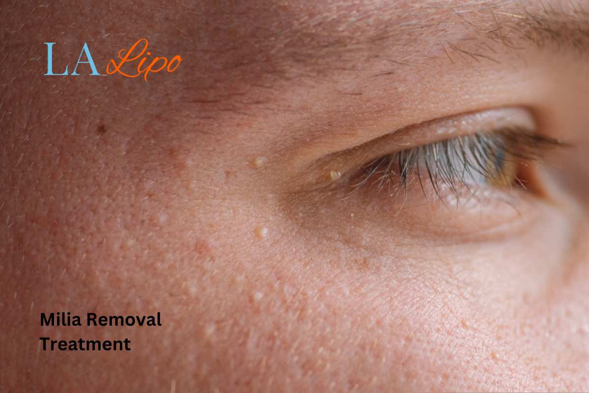 Cryopen Milia Removal: Is It the Easiest and Safest Option Kenilworth?