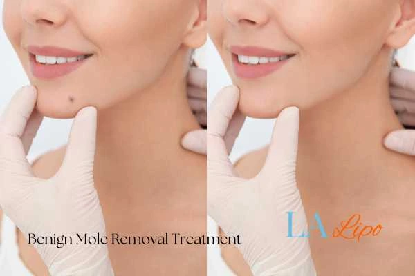 woman's before and after mole removal Kenilworth results