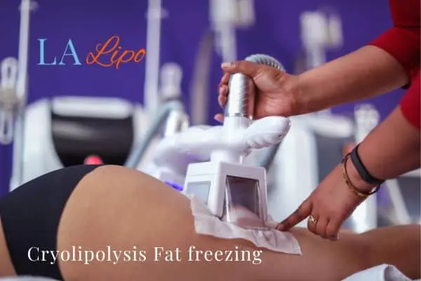 women getting fat freezing Kenilworth