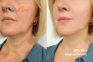 hi-fu for wrinkles Kenilworth before and after results