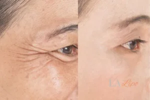 Before and after results of woman - HI-fu wrinkles reduction treatment Kenilworth