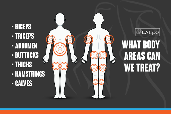 Graphic to show areas you can have LA-EMS Body Sculpting Kenilworth treatment.