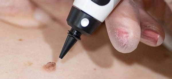 skin tag removal using cryopen Kenilworth