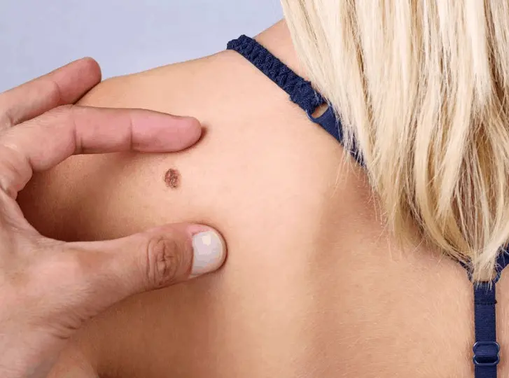 woman having mole removal Kenilworth consultation before treatment.