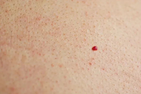 close up of a cherry angioma Kenilworth