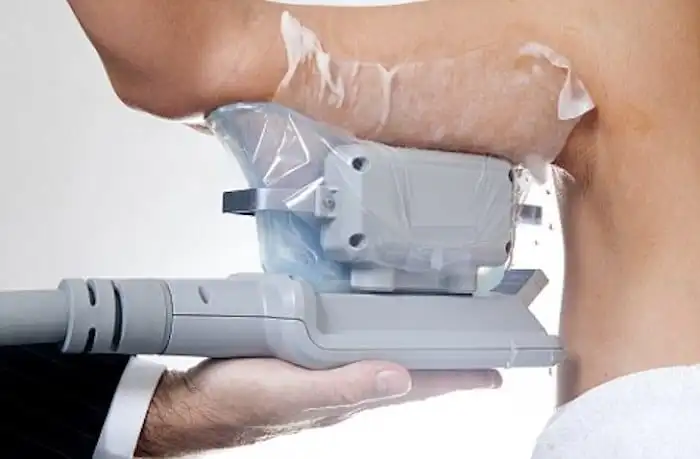 Picture of fat freezing Kenilworth on the upper arms.