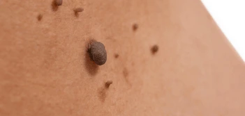 image of a skin tag Kenilworth