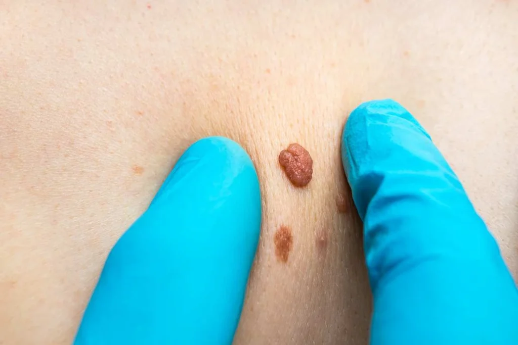 Consultant examining a skin tag Kenilworth