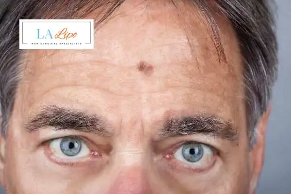Solar Lentigo Removal Kenilworth image of man with mark on his forehead
