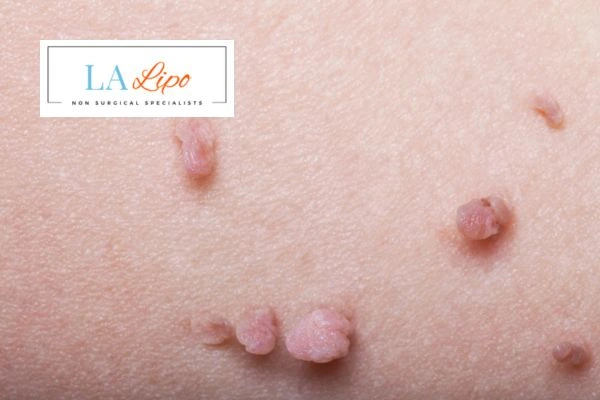 Does cryopen skin tag removal Kenilworth hurt? Find out now call our team today!