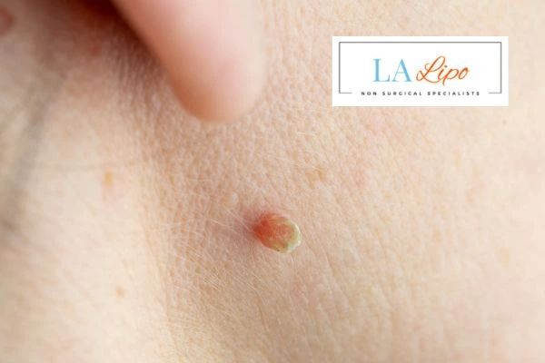 Book skin tag removal Kenilworth today speak to our team now!