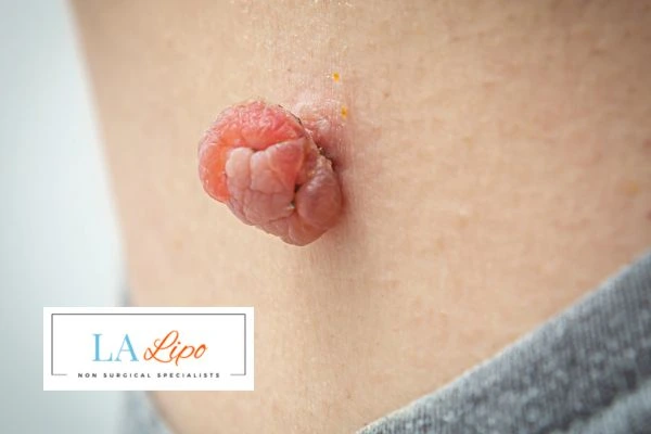 Interested in skin tag removal Kenilworth? Concerned about the pain? Find out more today!