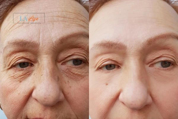 The powerful benefits of Morpheus8 Treatment Kenilworth - Call Our team today!
