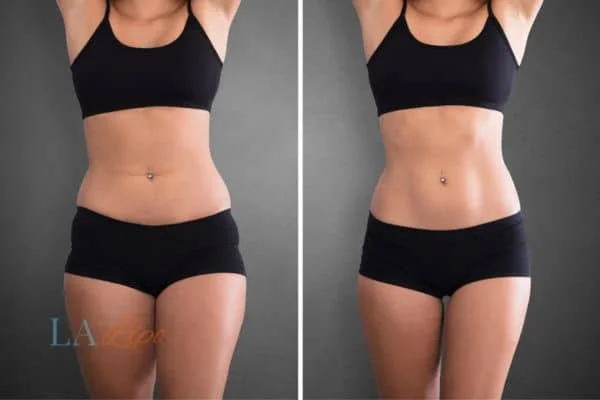 before and after results of non-surgical treatment to help a woman's body image and mental health Kenilworth