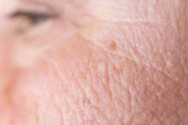 close up picture of a woman's face showing an age spot Kenilworth