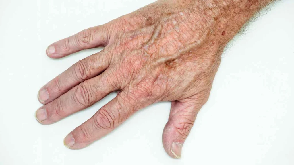 Male hand showing age spot Kenilworth