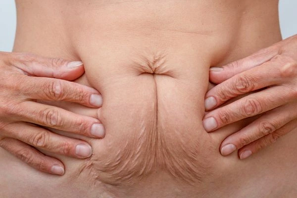 Image of a woman's stomach with loose skin - example of skin tightening Kenilworth options