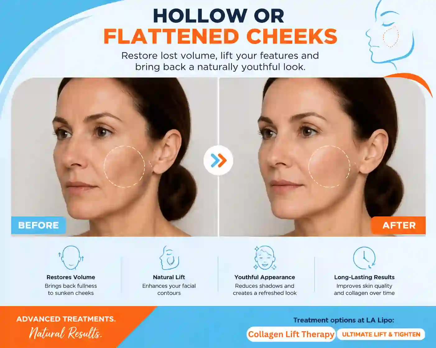 Sign #4: Hollow or Flattened Cheeks Kenilworth